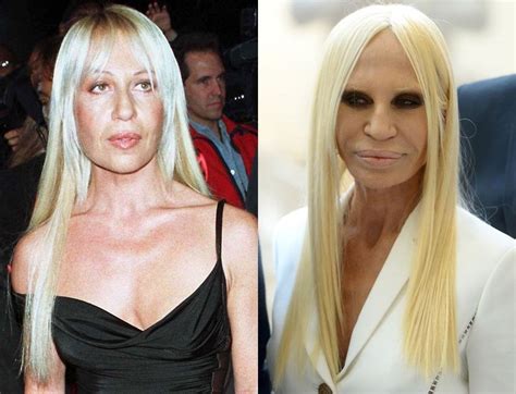 versace woman pladtic surgery|donatella Versace before and after.